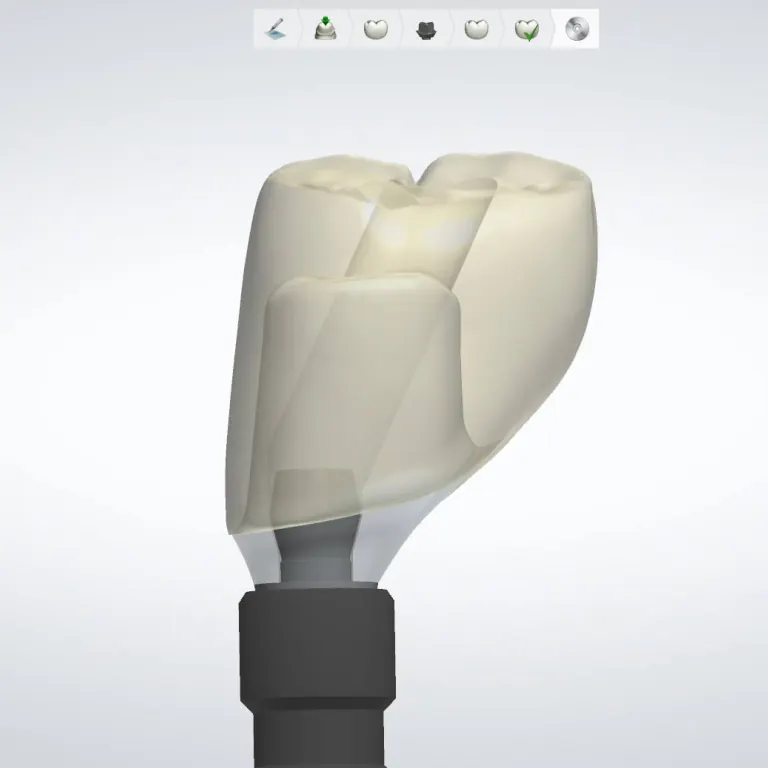 ASC, MUA, Locator abutment