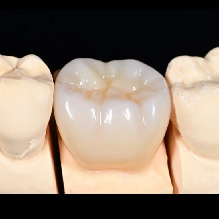 High translucent zirconia crown