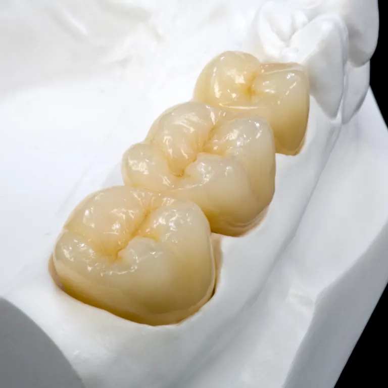 Multi-layer zirconia bridge
