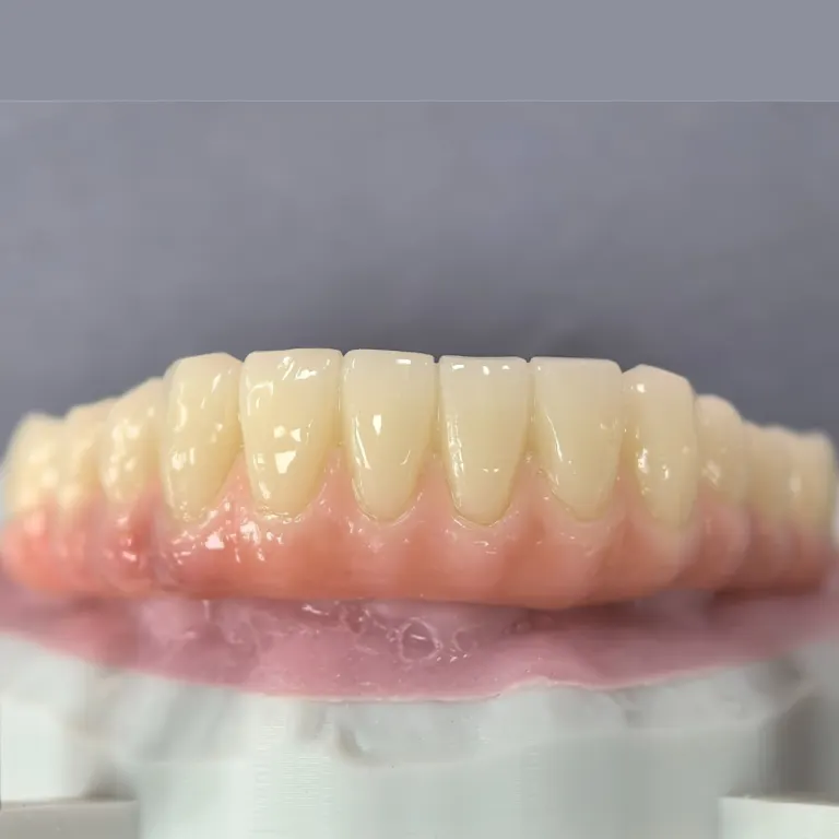PMMA temporary arch